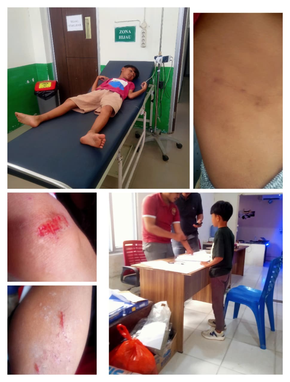 KASUS DUGAAN TINDAK PIDANA PENGANIAYAAN ANAK DIBAWAH UMUR YANG TERJADI DI DESA KARANGAN KABUPATEN LANDAK SAMPAI SAAT INI MENJADI SOROTAN